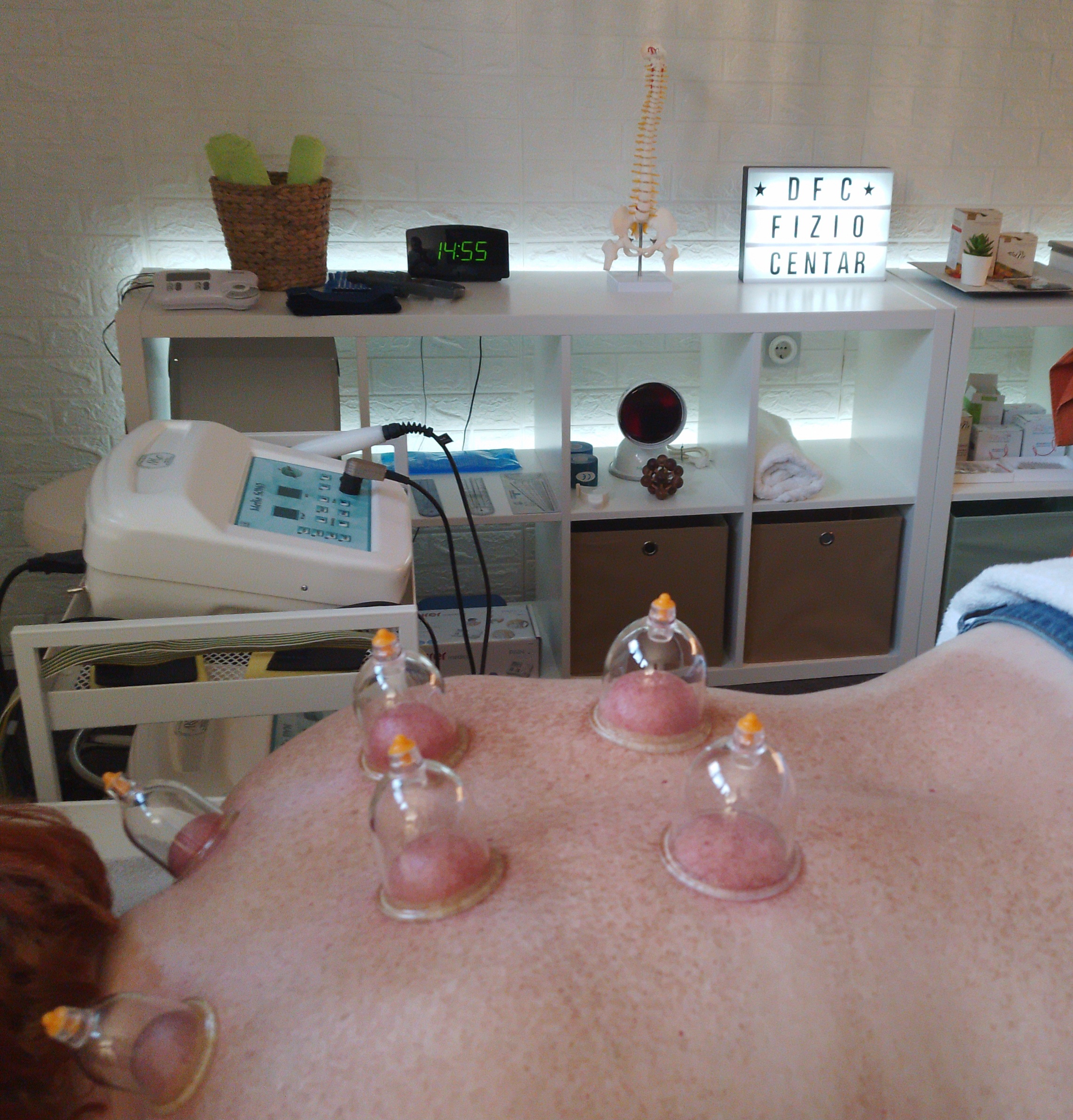 Cupping terapija